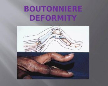 Deformity boutonniere Boutonniere Deformity